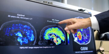 Con demenza 1,4 milioni di italiani, la quota più alta in Ue