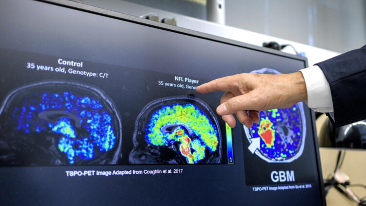 Con demenza 1,4 milioni di italiani, la quota più alta in Ue