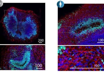 Studio italiano, ‘la Sma colpisce dall’embrione, cruciali screening e cure precoci’