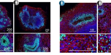 Studio italiano, ‘la Sma colpisce dall’embrione, cruciali screening e cure precoci’